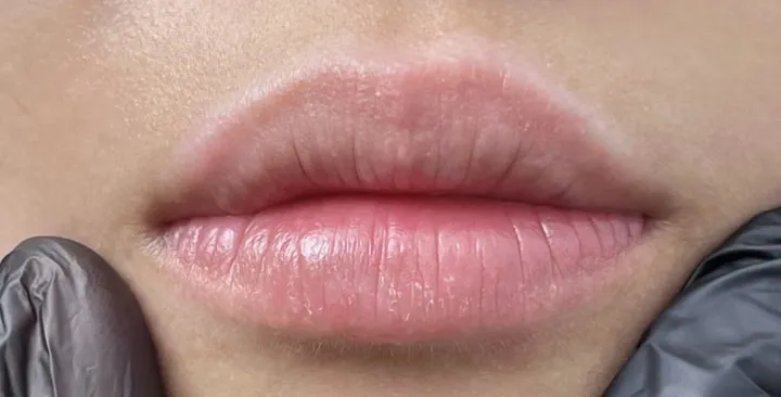 Khử thâm môi — sau khi làm tại KIMLY