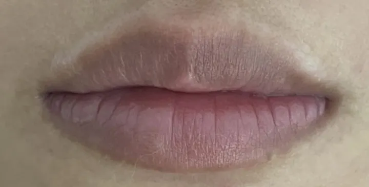 Khử thâm môi — trước khi làm tại KIMLY