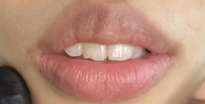 Tái cấu trúc sắc tố môi — sau khi làm tại KIMLY