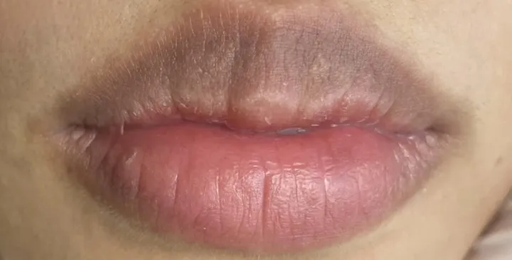 Tái cấu trúc sắc tố môi — trước khi làm tại KIMLY